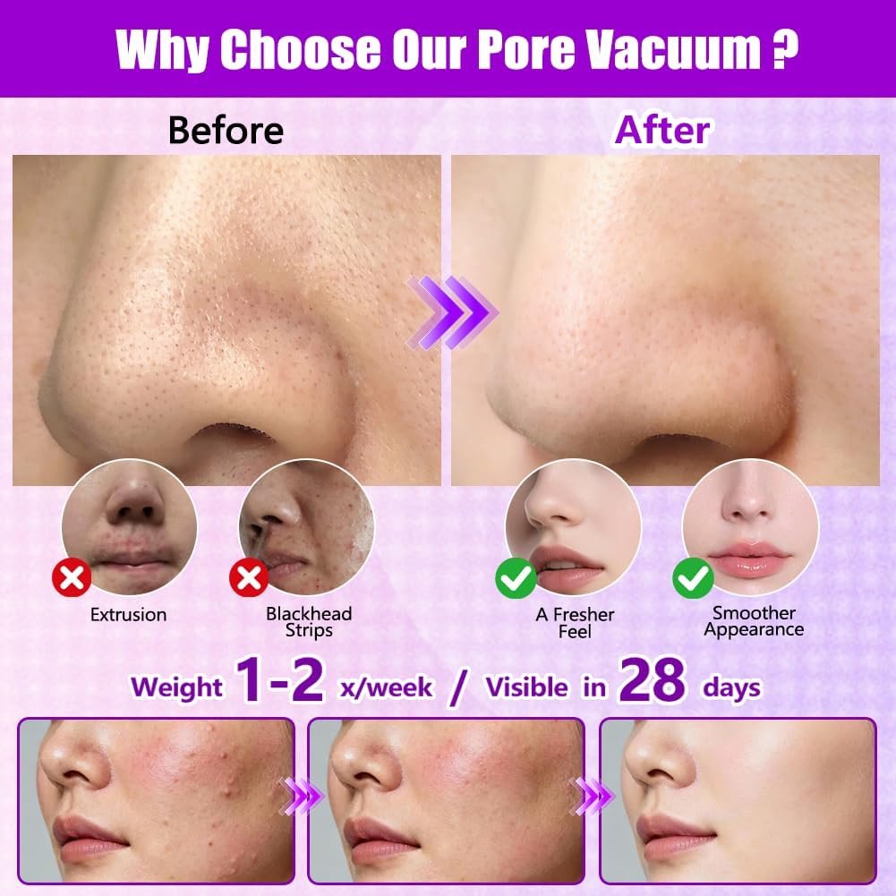 Blackhead Remover Vacuum with Heating, Pore Vacuum 3 Suction Levels, 5 Suction Heads, 9 Pattern,Pore Extractor with Pimple Popper Tool for Women & Men,for Nose,T-Zone, Chin Face Deep Pore Cleansing